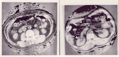 Images of Hounsfield's own abdomen, taken on a prototype body machine in the laboratory. They were shown at the Bermuda conference in 1975.