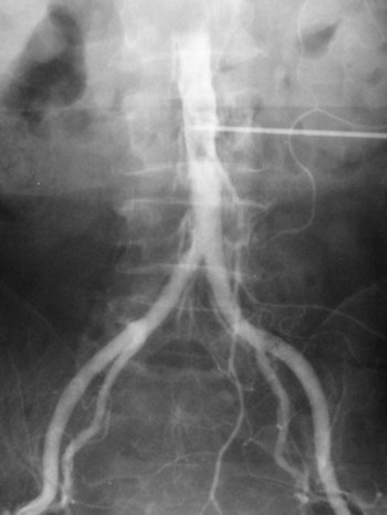 Translumbar aortogram