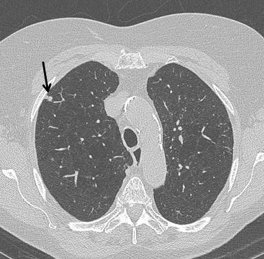 lung cancer caused by asbestos exposure