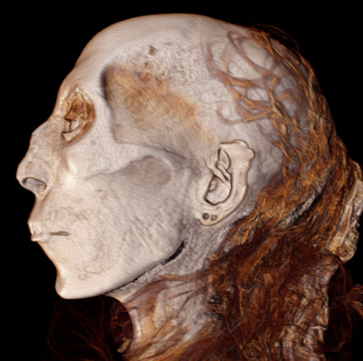 3D CT image of the profile of Thuya
