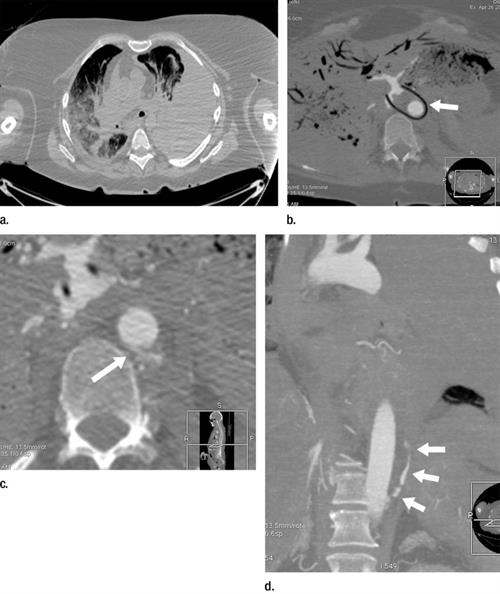 Postmortem CT and CTA of 59-year-old woman