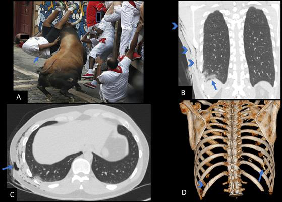 2-year-old man gored in the right side of the chest wall