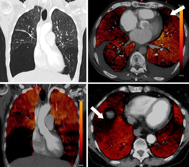 Coronal images of 49-year-old woman with alpha-1 antitrypsin deficiency show advanced lower lobe emphysema with correlating PBV defects