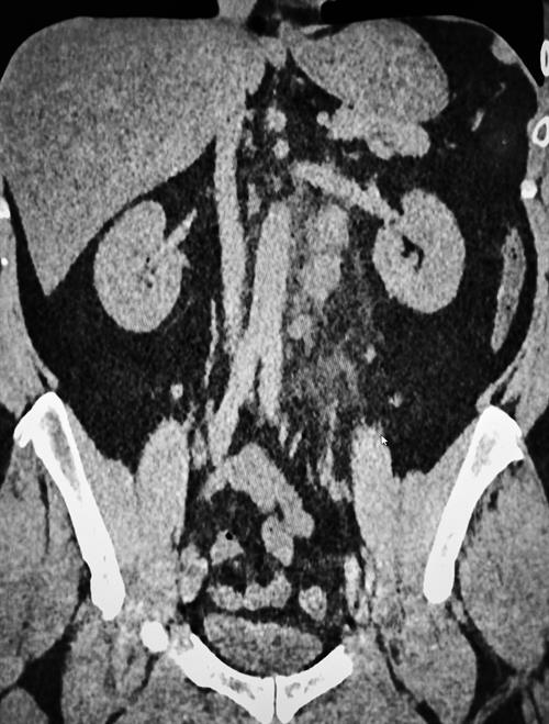 CT shows mild ground-glass lesions and retroperitoneal lymph nodes with inflammatory fat reaction