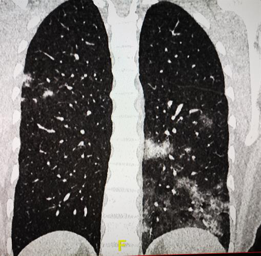 CT reveals patchy ground-glass lesions, left lower lobe predominant