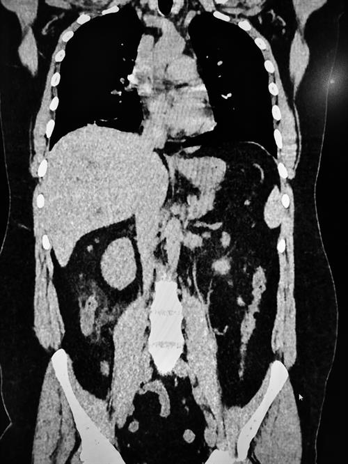 Lower chest CT slices show some ground-glass lesions, and a chest CT confirms COVID-19 suspicion