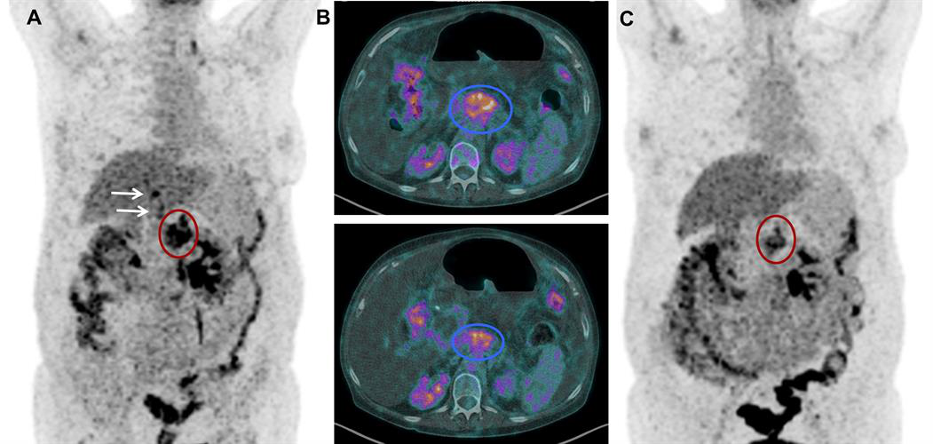 FDG-PET and CT scans of a patient before and after treatment