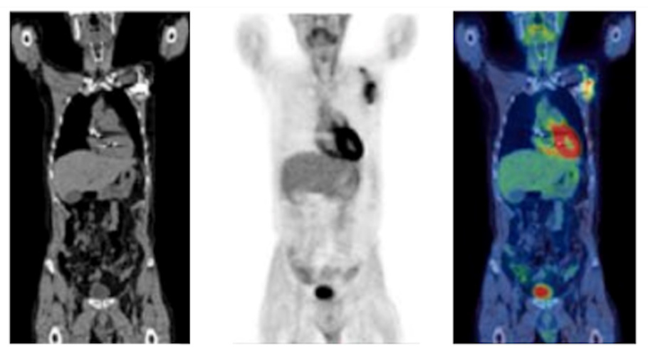 F-18 FDG PET/CT in the assessment of an infected cardiac pacemaker