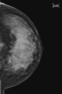 breast MRI