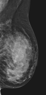 breast MRI