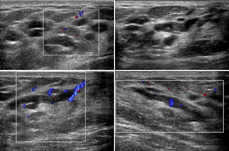 Breast ultrasound images revealed only benign findings