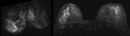 Breast MRI showed a suspicious non-mass-like enhancement in the right breast
