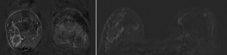 Breast MRI showed a suspicious non-mass-like enhancement in the right breast