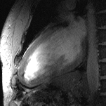 Cine image of the beating heart: two-chamber view