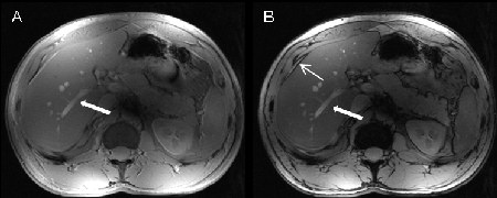 T1-weighted 2D in and opposed phase MRI