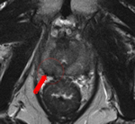 Axial T2-weighted MR image