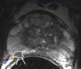 ESUR issues new guidance on best use of prostate MRI