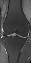 Knee MRI with Siemens Healthcare Magnetom Prism 3-tesla system