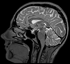 Brain MRI with Siemens Healthcare Magnetom Prism 3-tesla system