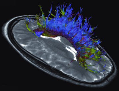 Diffusion-tensor imaging can help to improve visualization of white-matter fiber tracts