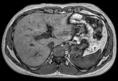 Dynamic liver imaging using the mDixon technique