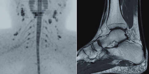 MRI of the posterior triangle of the neck using DWIBS and high-resolution, proton density-weighted image of the ankle