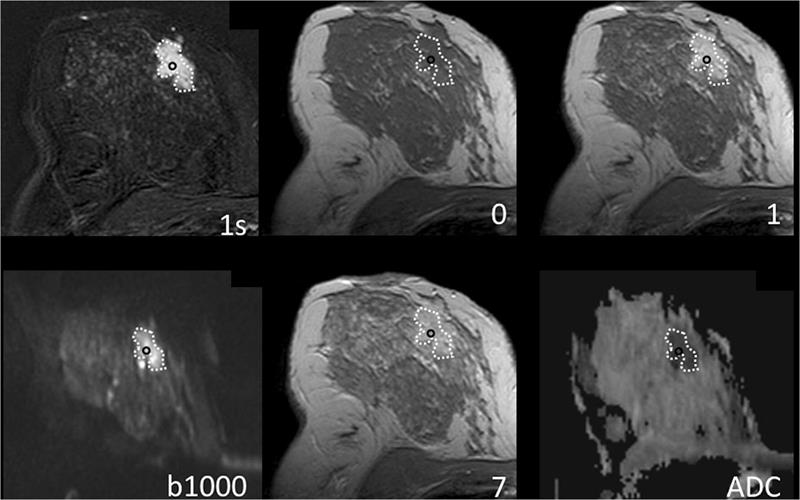 Breast MRI of a 41-year-old woman with grade 2 invasive ductal cancer