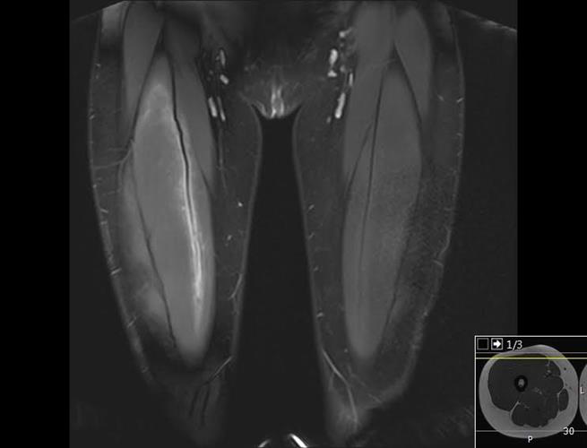 Coronal image of a 17-year-old soccer player who has had two weeks with pain