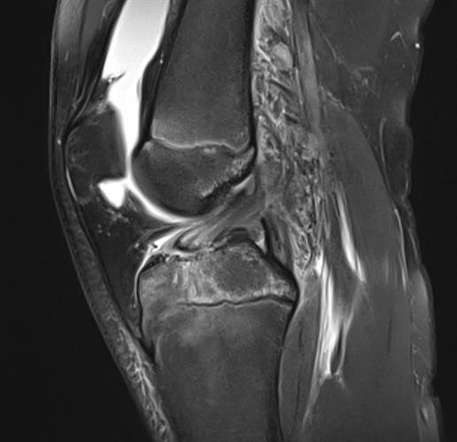 Sagittal proton-density fat-suppressed image shows an avulsion of the distal insertion of the anterior cruciate ligament, with some diastasis