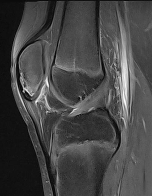 Sagittal image shows stress reaction in the inferior part of the patella and changes suspicious of patellar sleeve avulsion