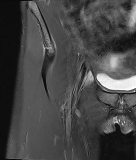 Injury to the proximal origin is shown on a coronal image of the rectus femoris, with a partly avulsed fragment from the spina iliaca anterior inferior