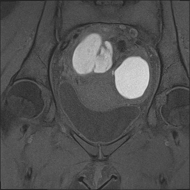 Coronal T2- and T1 fat-saturated imaging demonstrates bilateral ovarian endometriomas