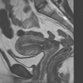 Sagittal T2-weighted imaging through midline uterus
