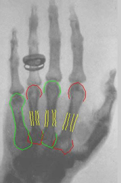 hand x-ray by Roentgen